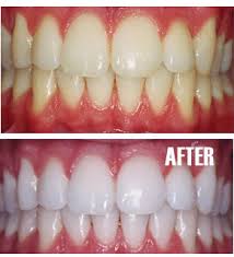 Teeth-Bleaching-And-Whitening1