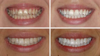 Teeth-Bleaching-And-Whitening2