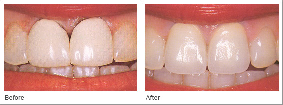 crown-before-after1