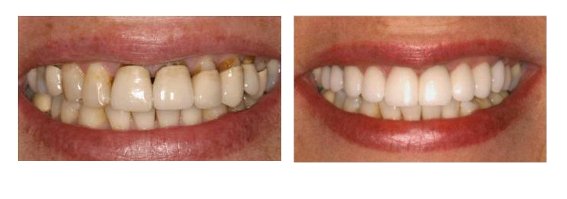 dental-crown-before-after21