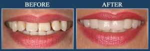 veneers-before-and-after2