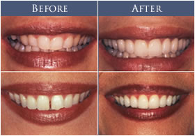 veneers-before-and-after3
