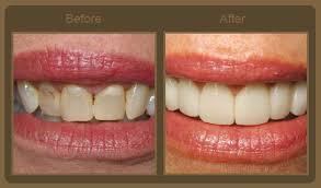 veneers-before-and-after4
